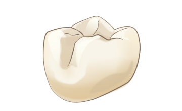 臼歯部セラミック